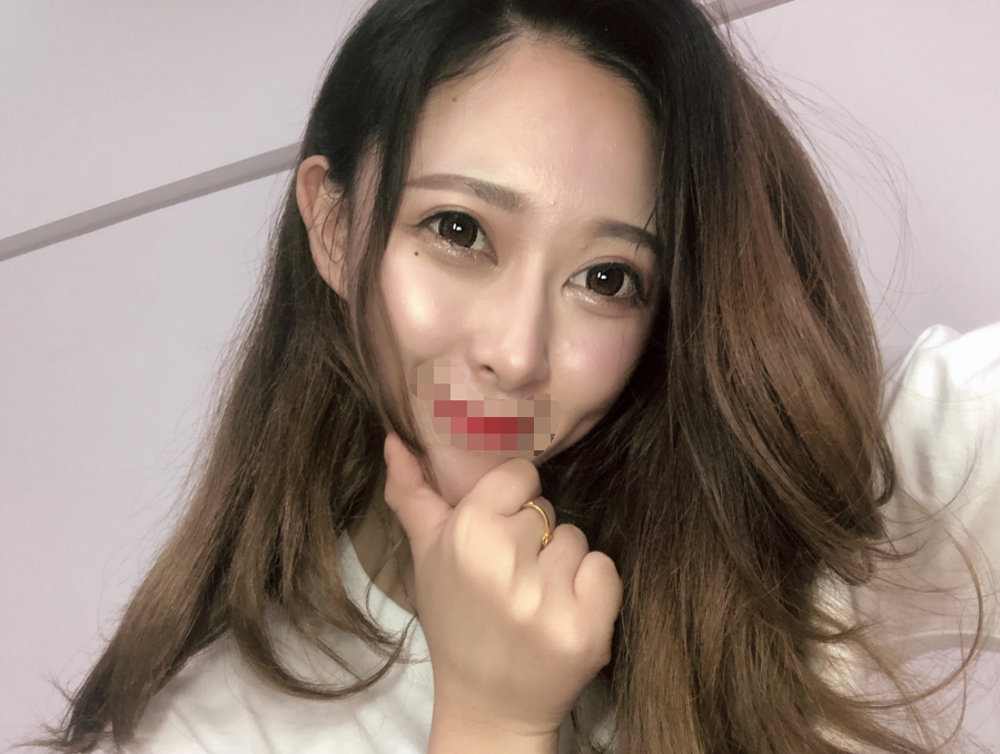 埋线双眼皮术后第102天