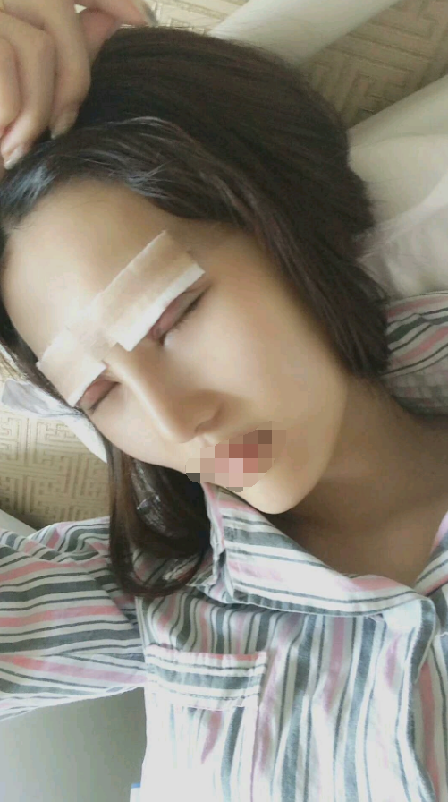 全切双眼皮术后当天 济宁杏林怎么样