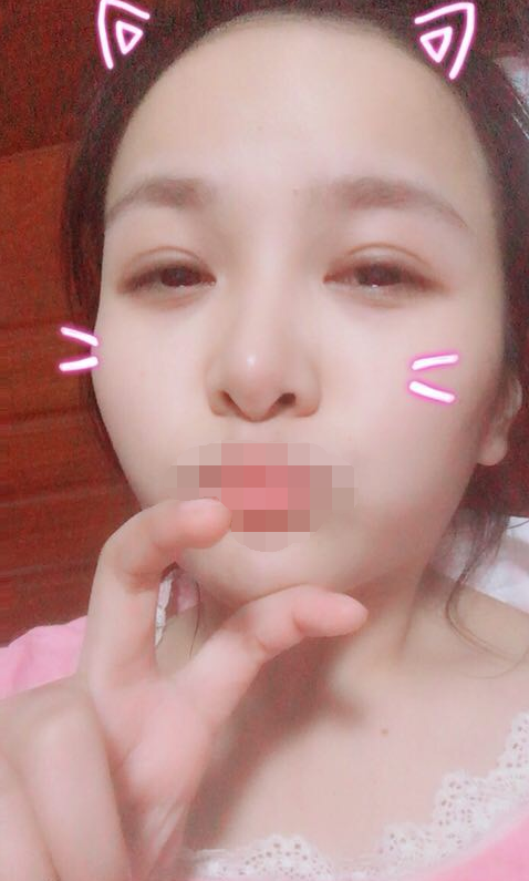 全切双眼皮一个月了 重庆伯思立医院怎么样?