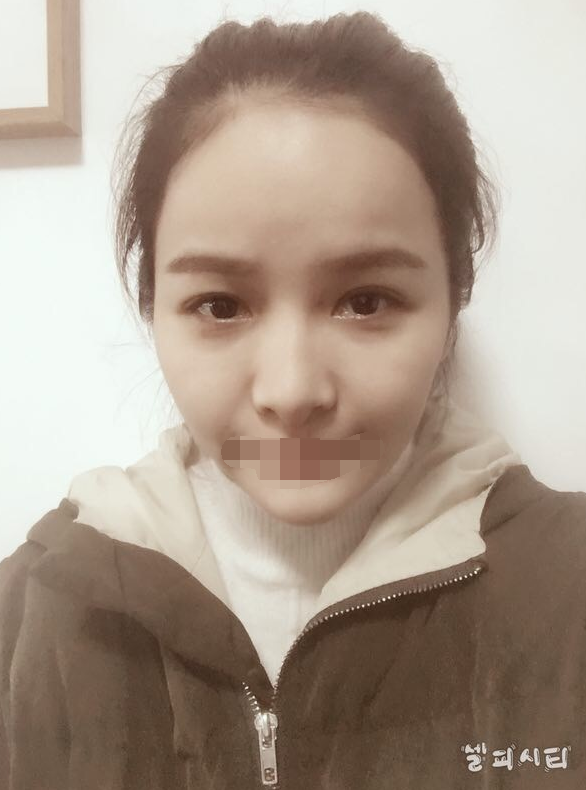 全切双眼皮一个月了 重庆伯思立医院怎么样?