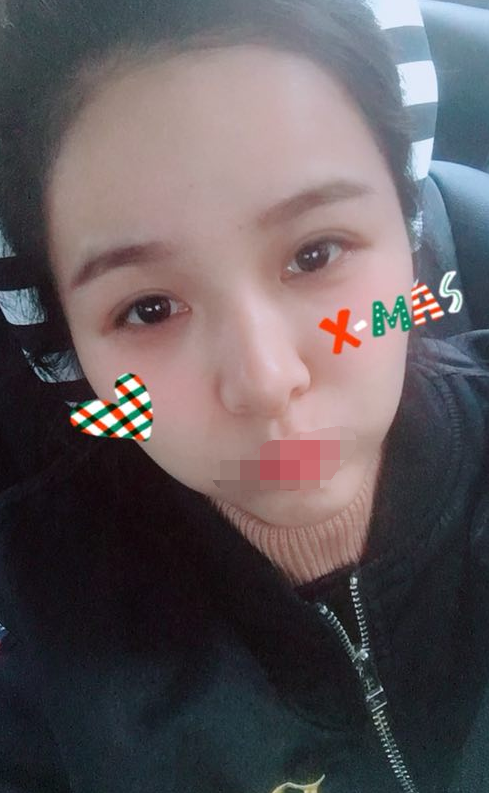 全切双眼皮一个月了 重庆伯思立医院怎么样?