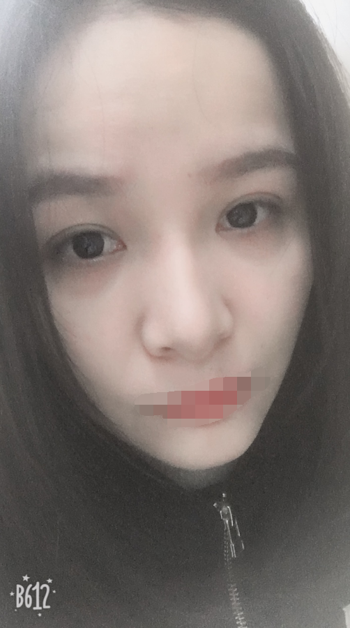 全切双眼皮一个月了 重庆伯思立医院怎么样?