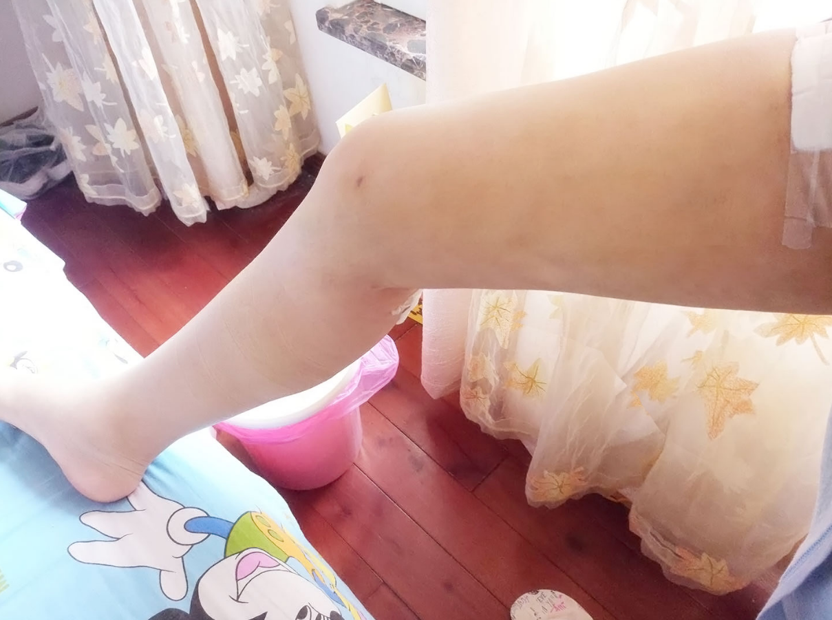 吸脂瘦全身术后两个月了 北京东方和谐怎么样