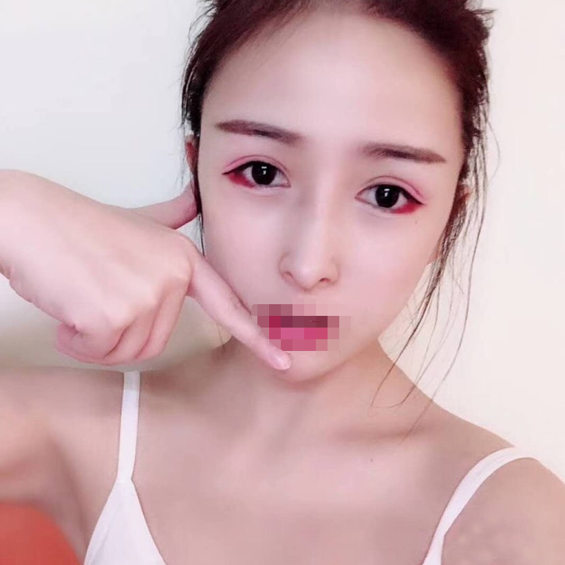下眼下至矫正手术 术后一百天 *果图对比