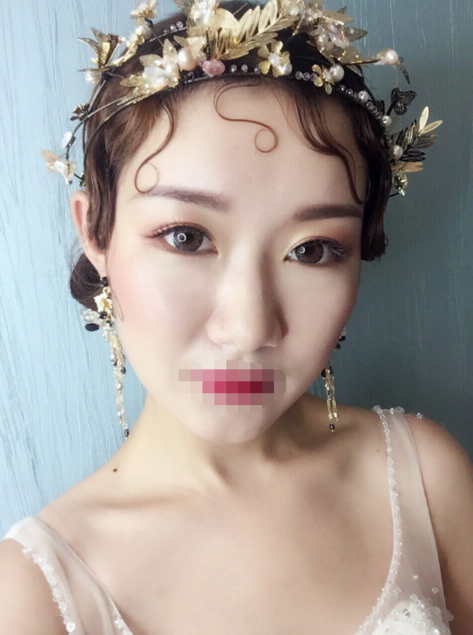 下颌角磨骨削骨整形 北京王侠怎么样？预约