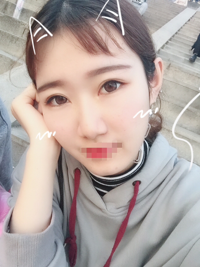 下颌角磨骨削骨整形 北京王侠怎么样？预约