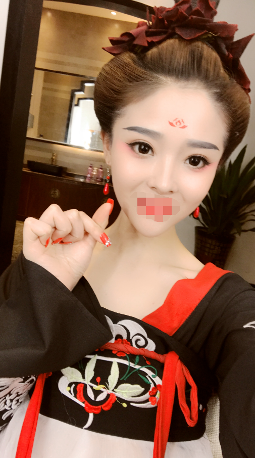 综合隆鼻术后57天 武汉美莱技术怎么样多少钱