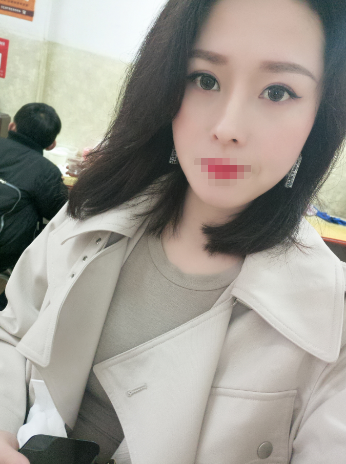 一个月了我做的硅胶隆鼻 觅美网推荐做的满月了