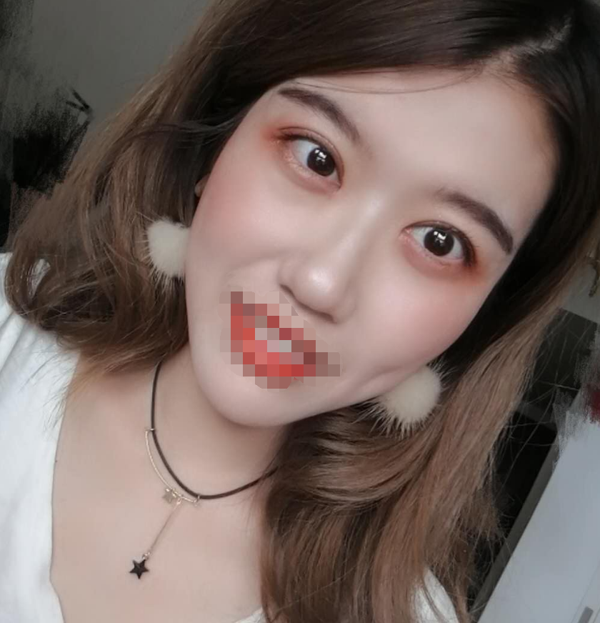 【全切双眼皮微创开眼角案例图】上海九院整形科朱海男 王梓 黄如林 苏薇洁 周一雄 谢峰 双眼皮技术怎么样？