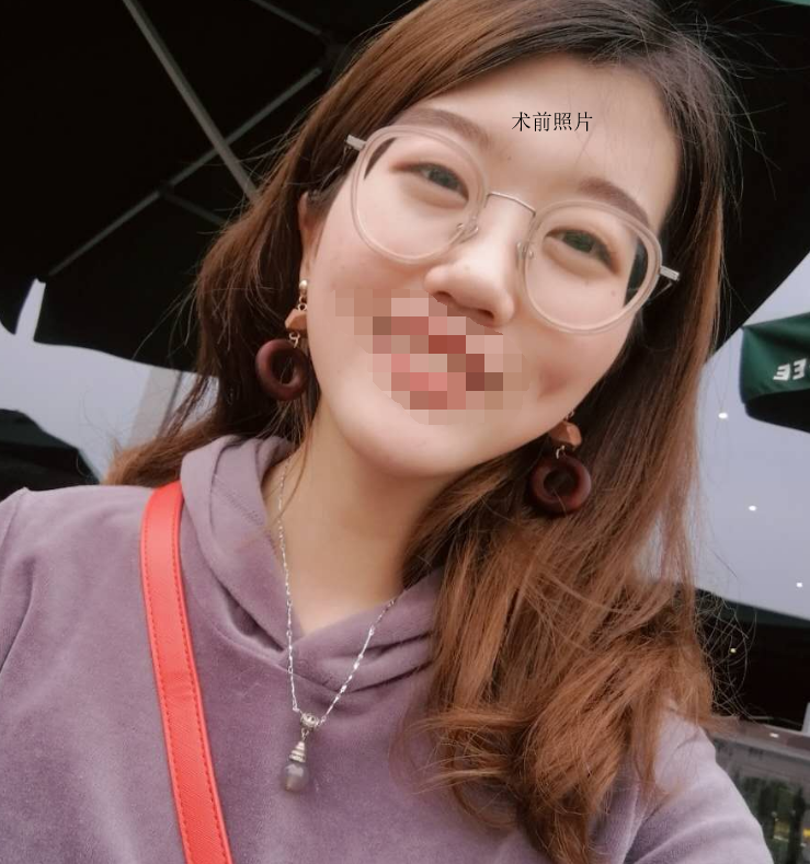 【全切双眼皮微创开眼角案例图】上海九院整形科朱海男 王梓 黄如林 苏薇洁 周一雄 谢峰 双眼皮技术怎么样？