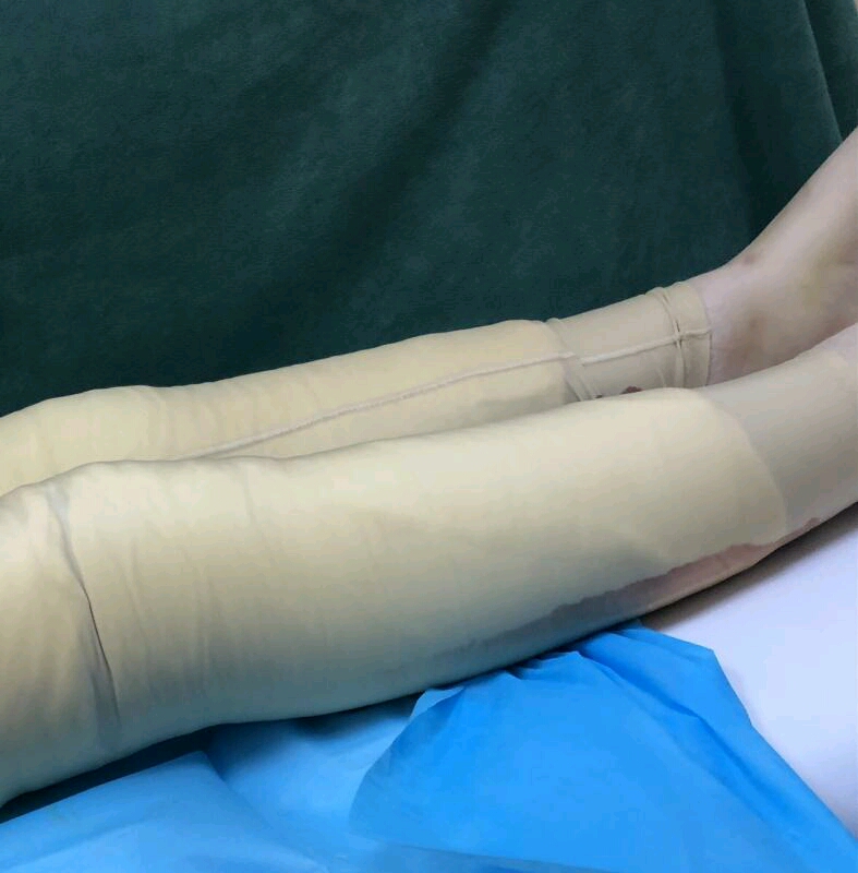 【小腿吸脂术后当天】北京东方和谐吸脂多少钱?王自谦和冯斌技术怎么样?