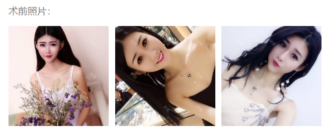 【做完隆胸一个月*果图】广州家庭医生自体脂肪隆胸价格多少钱(案例图)
