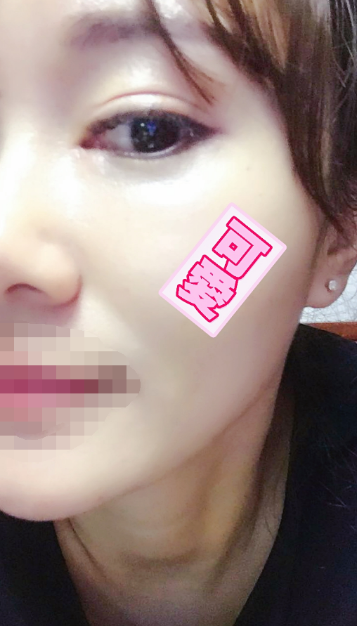 眼部综合全切双眼皮(平行型双眼皮)术后快一年了