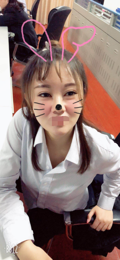 眼部综合全切双眼皮(平行型双眼皮)术后快一年了