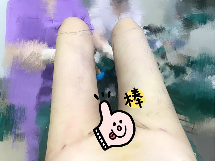 【吸脂瘦大腿术后第1天】上海第九人民医院曹卫刚吸脂多少钱