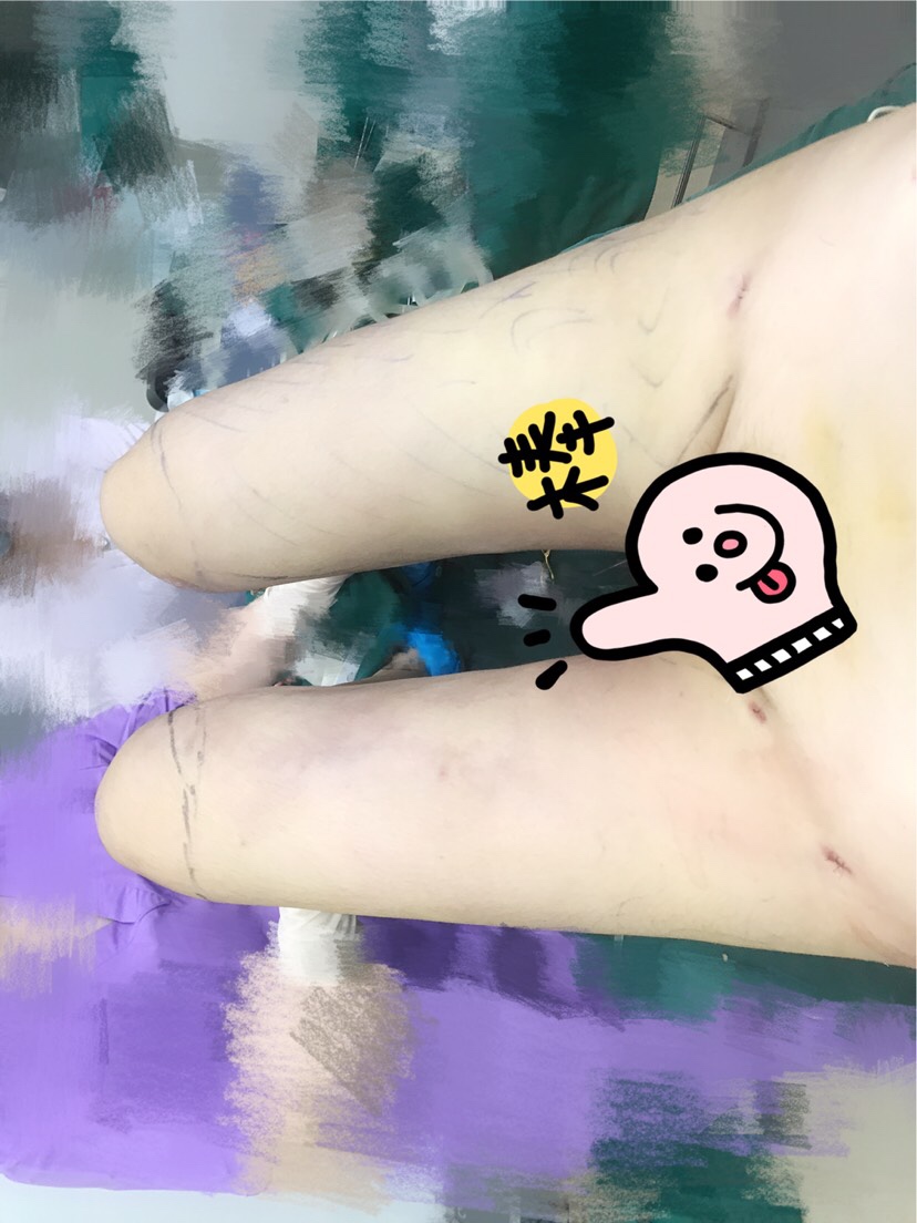 【吸脂瘦大腿术后第1天】上海第九人民医院曹卫刚吸脂多少钱