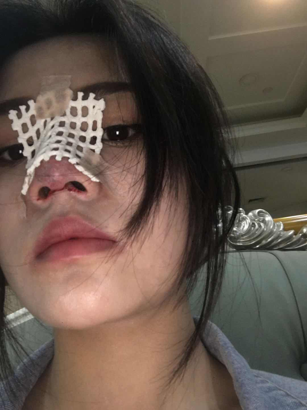 膨体隆鼻术后第2天感觉熬过了一整个世纪!!