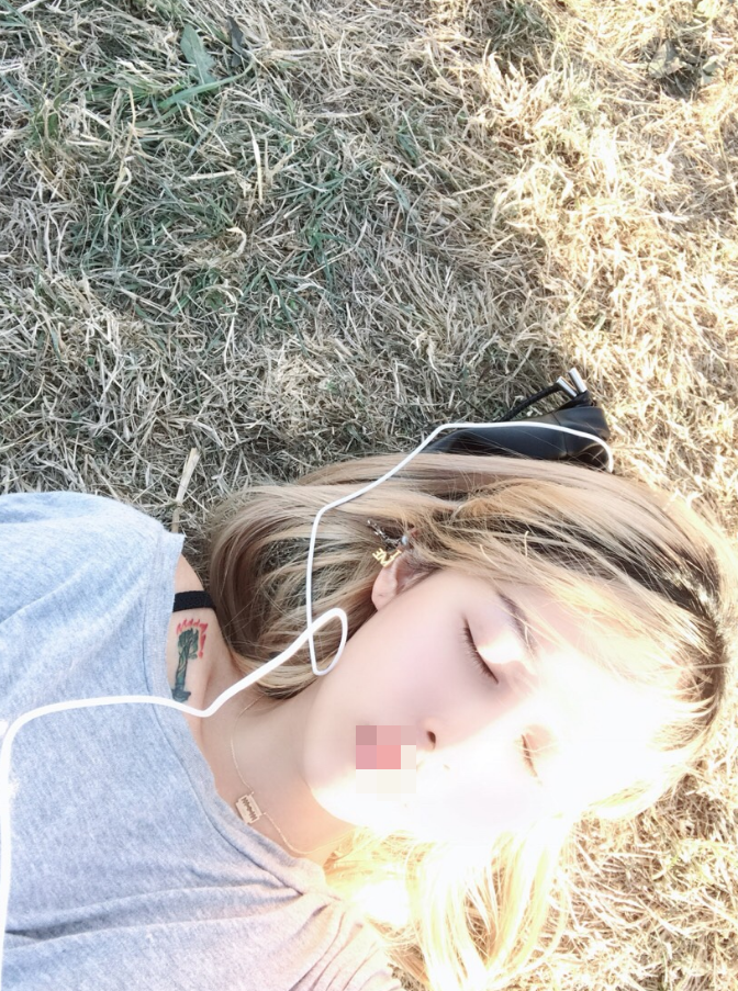 种植发际线术后第330天 宝贝们,我来更新啦!