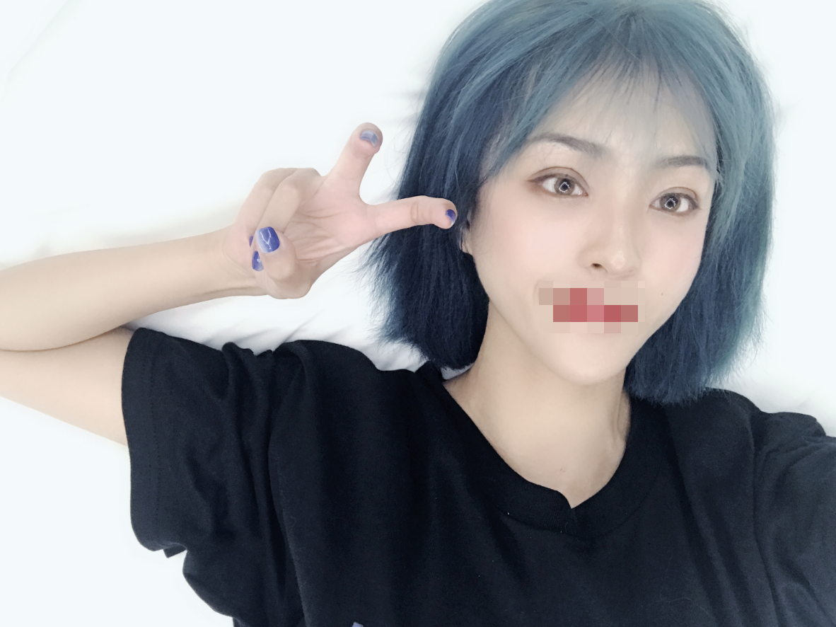 广州做的全切双眼皮快一个月了~