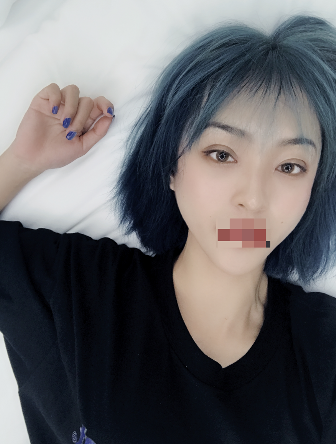 广州做的全切双眼皮快一个月了~