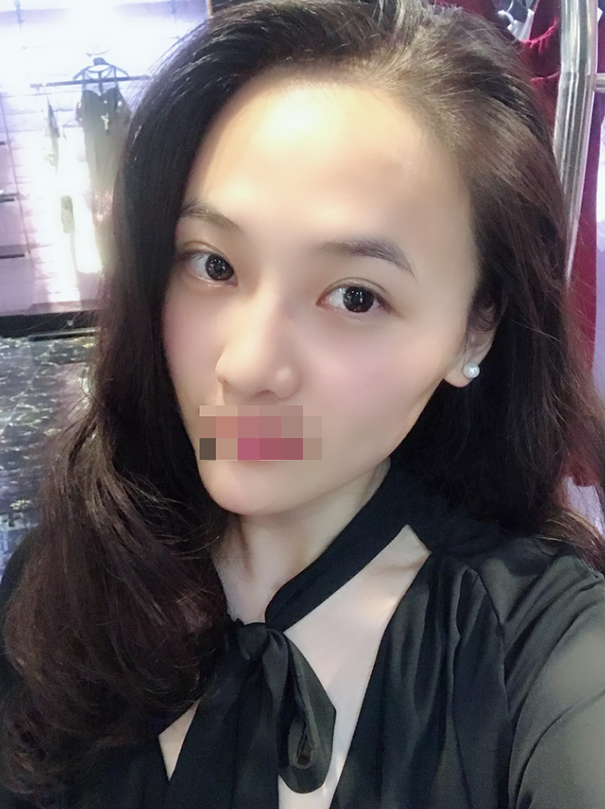 硅胶垫下巴178天咯 看看我的网红款下巴