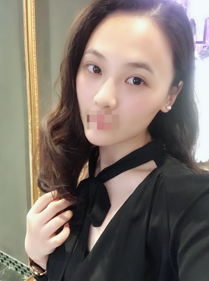 硅胶垫下巴178天咯 看看我的网红款下巴