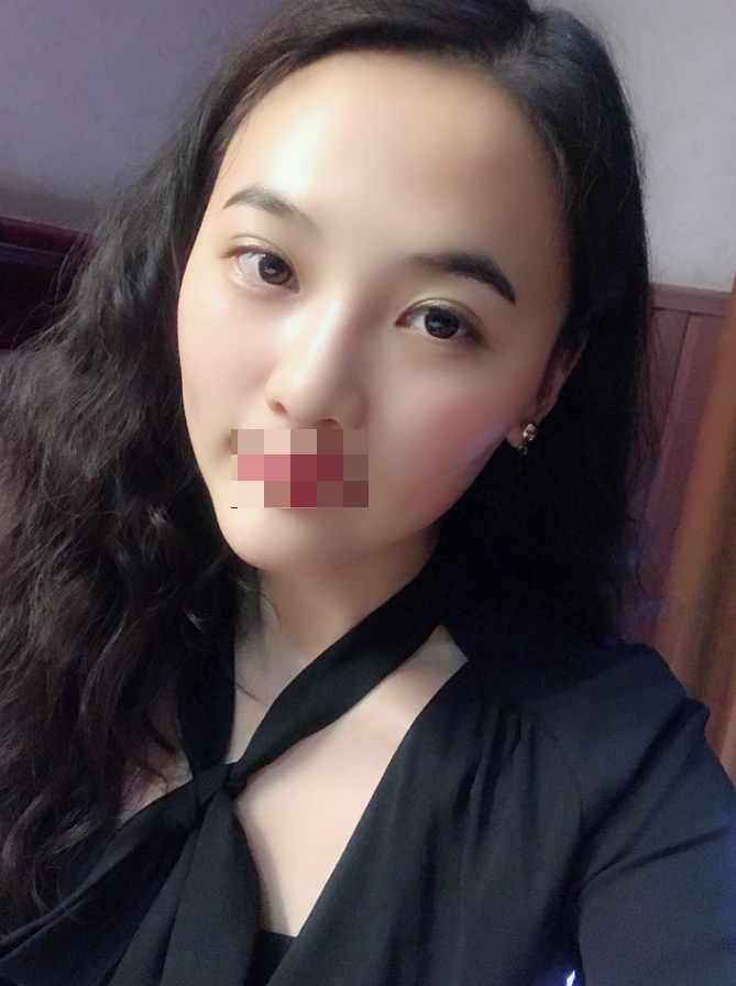 硅胶垫下巴178天咯 看看我的网红款下巴