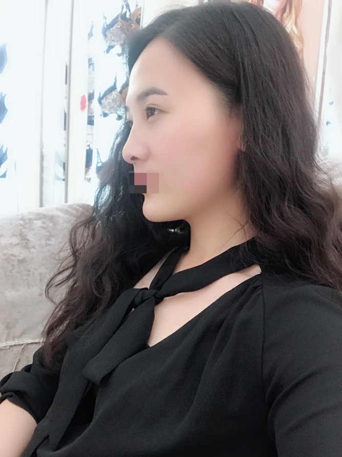 硅胶垫下巴178天咯 看看我的网红款下巴