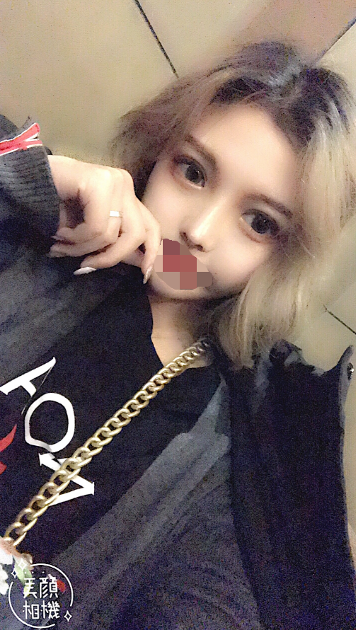 综合隆鼻术后第20天 鼻子现在一切正常