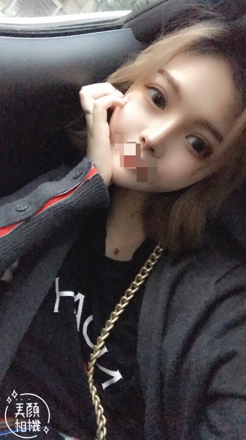 综合隆鼻术后第20天 鼻子现在一切正常