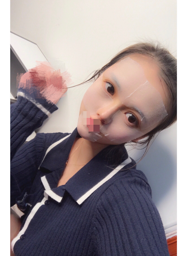 综合隆鼻术后第20天 鼻子现在一切正常