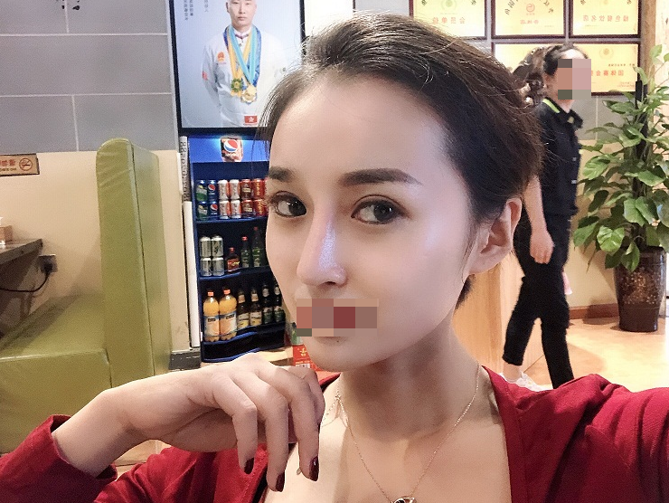 膨体隆鼻术后第118天终于要放假了