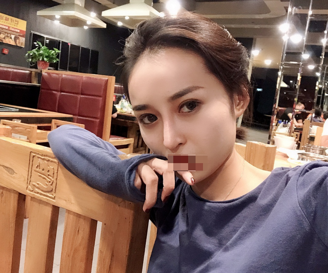 膨体隆鼻术后第118天终于要放假了