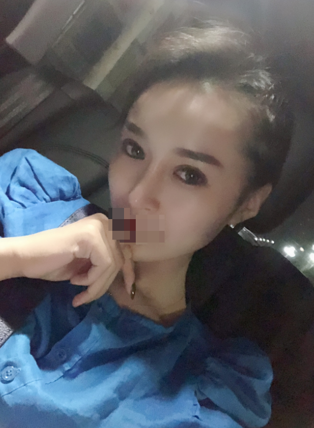 膨体隆鼻术后第118天终于要放假了