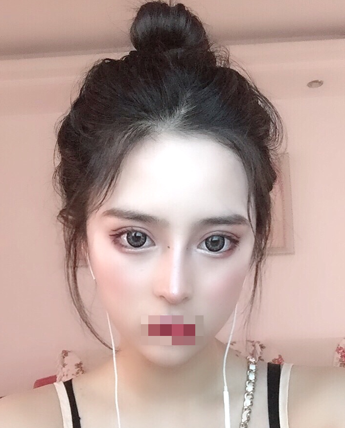 耳软骨复合隆鼻术后第85天*果图~