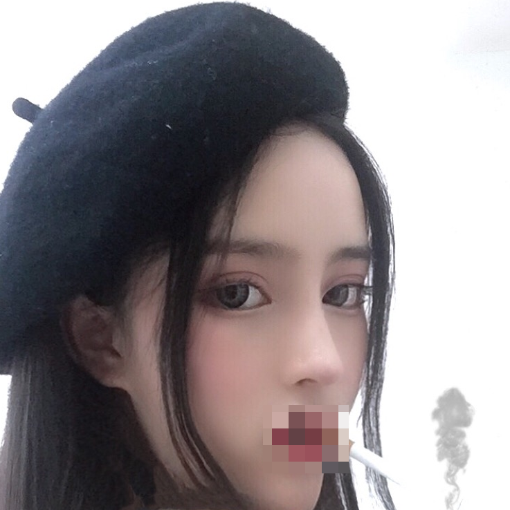 耳软骨复合隆鼻术后第85天*果图~