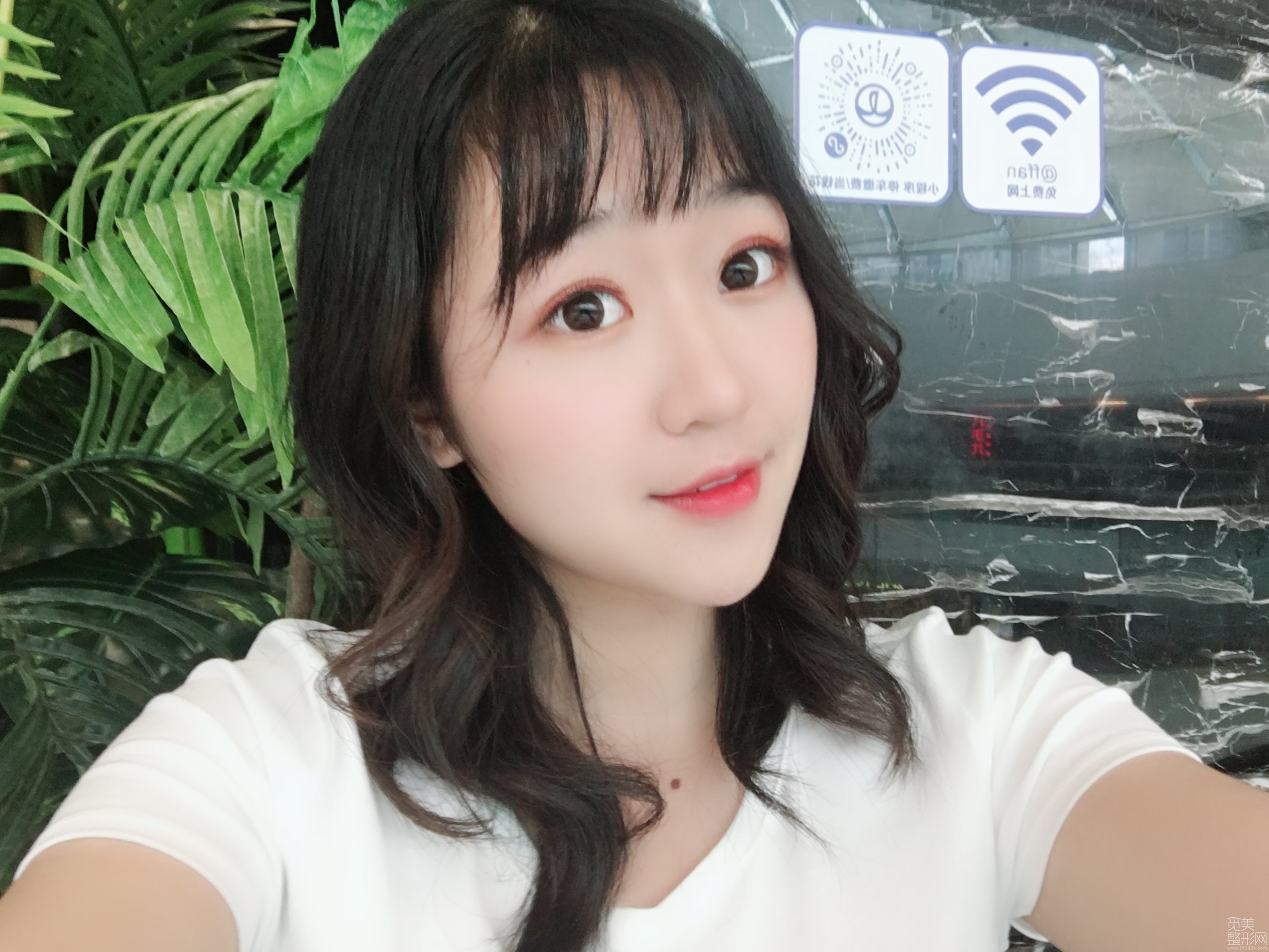 广州东莞做的自体脂肪全脸填充术后第10天感觉恢复的好快呀