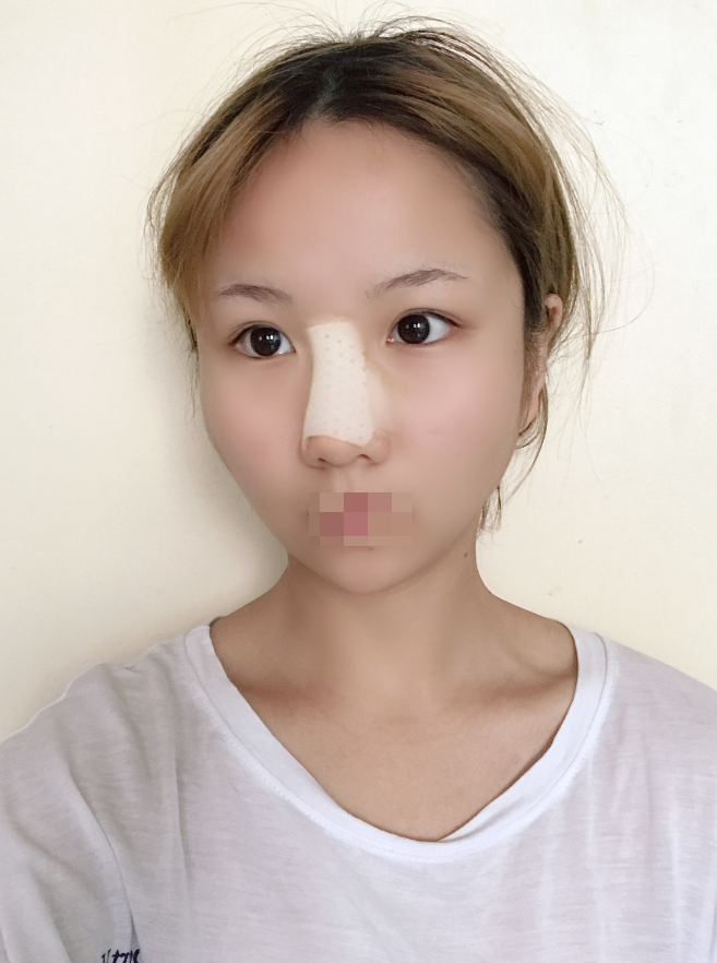 广州韩后隆*今天是我术后第一天