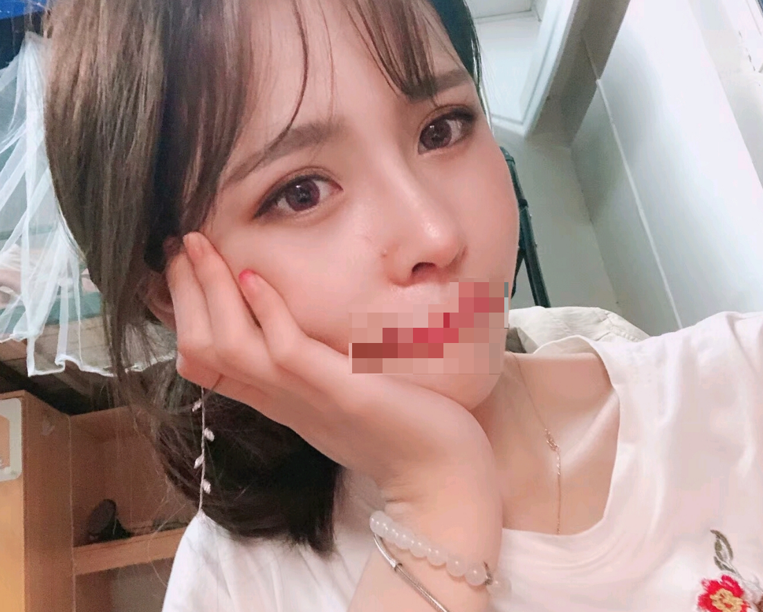 成都膨体隆鼻术后第72天了