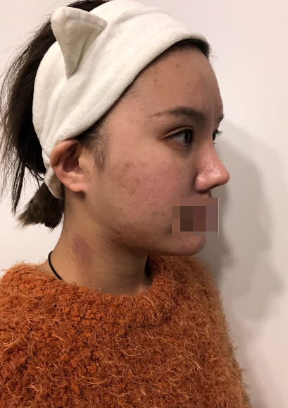 大连肋软骨隆鼻术后三个月啦~鼻基底毫无异物感 感谢 原容社 嘿嘿