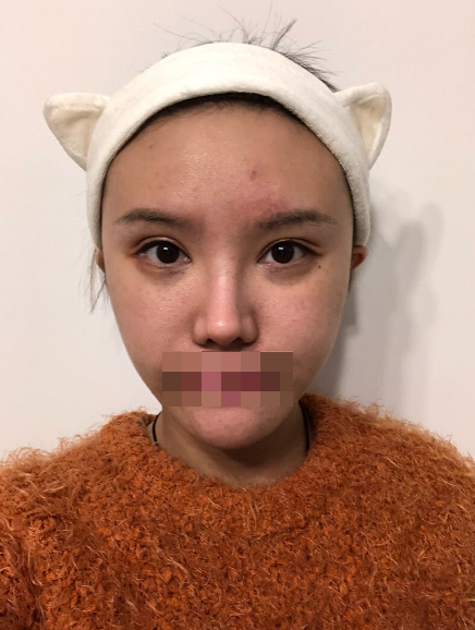 大连肋软骨隆鼻术后三个月啦~鼻基底毫无异物感 感谢 原容社 嘿嘿