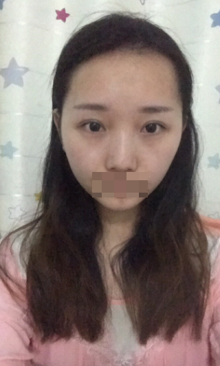 成都双眼皮修复今天是97天,三个多月了~原容社是解决了我所有不懂的问题