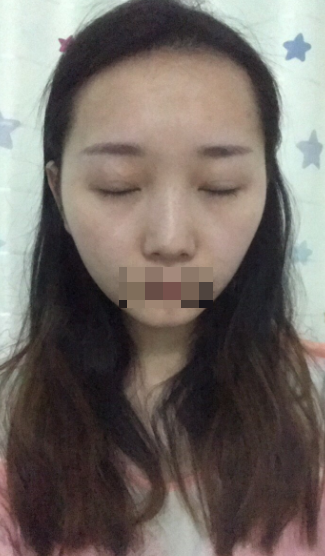 成都双眼皮修复今天是97天,三个多月了~原容社是解决了我所有不懂的问题