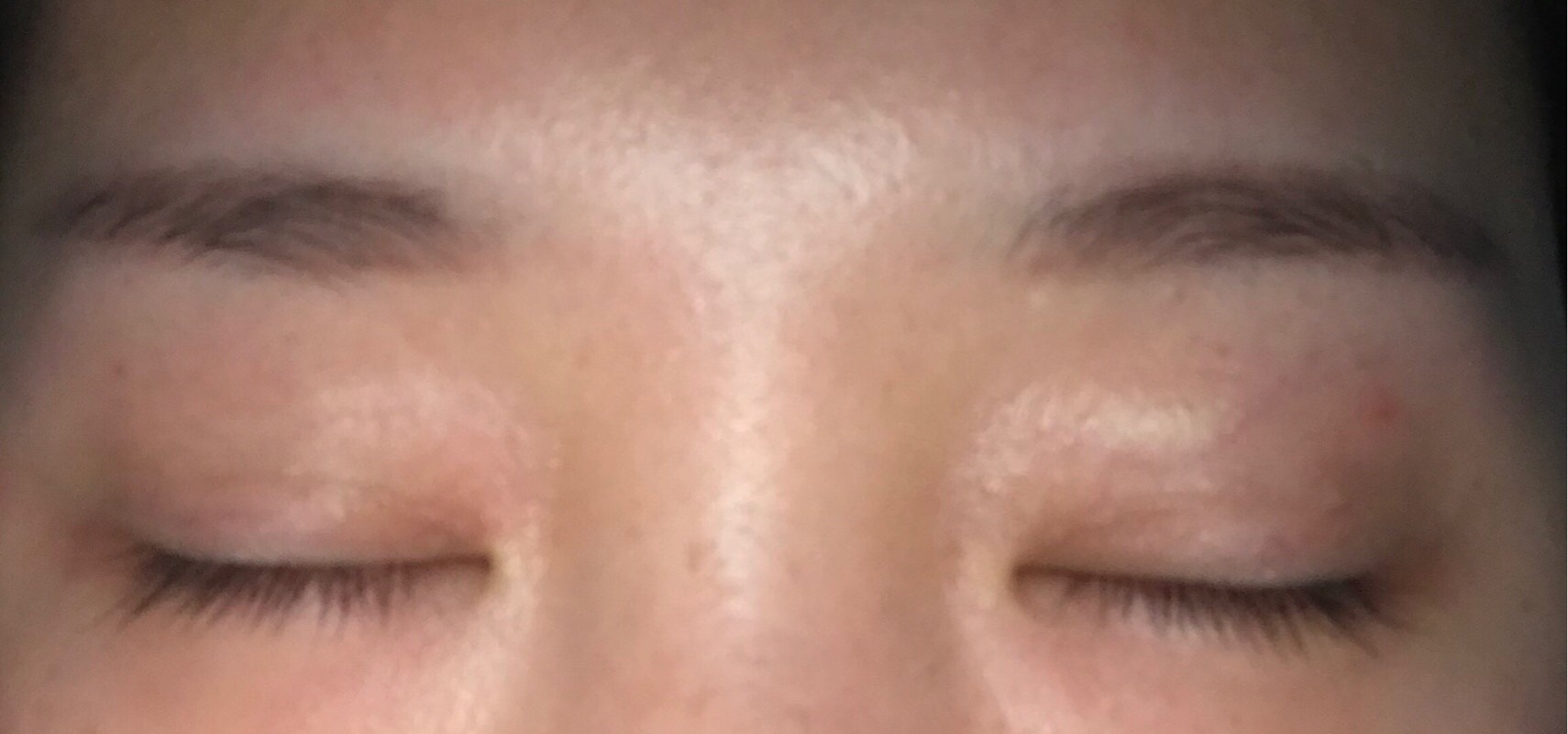 成都双眼皮修复今天是97天,三个多月了~原容社是解决了我所有不懂的问题