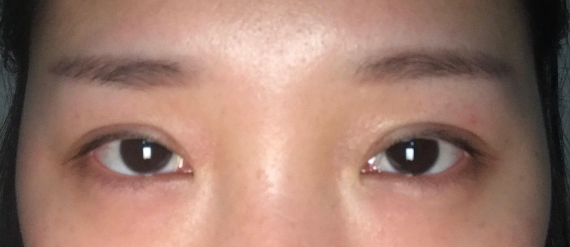 成都双眼皮修复今天是97天,三个多月了~原容社是解决了我所有不懂的问题