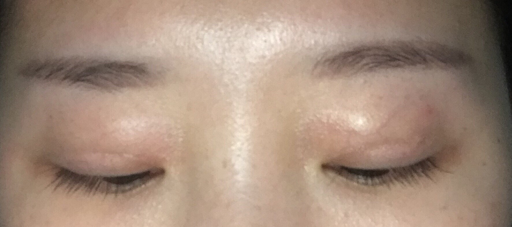 成都双眼皮修复今天是97天,三个多月了~原容社是解决了我所有不懂的问题