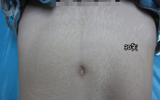 深圳去妊娠纹术后两个多月了呀~ 哪家医院好?价格多少钱?【详情咨询原容社】去整整吧~