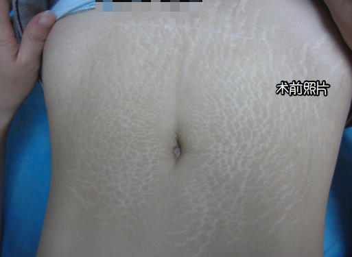 深圳去妊娠纹术后两个多月了呀~ 哪家医院好?价格多少钱?【详情咨询原容社】去整整吧~