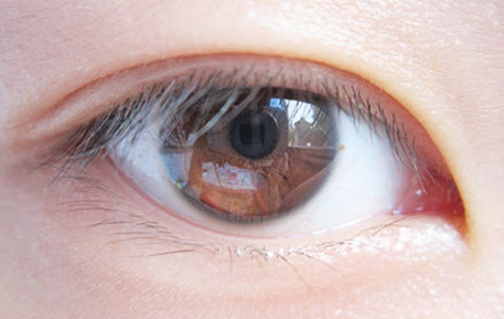割双眼皮术前术后都应该注意什么