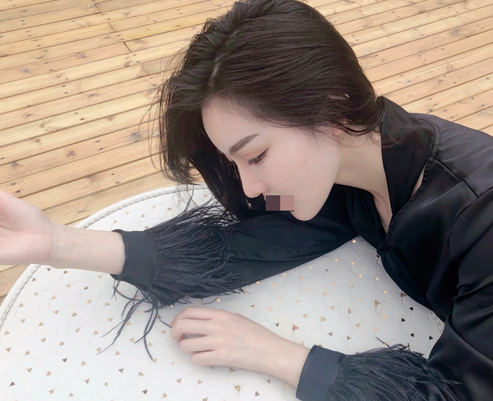杭州综合隆鼻术后一个半月 价格:38800